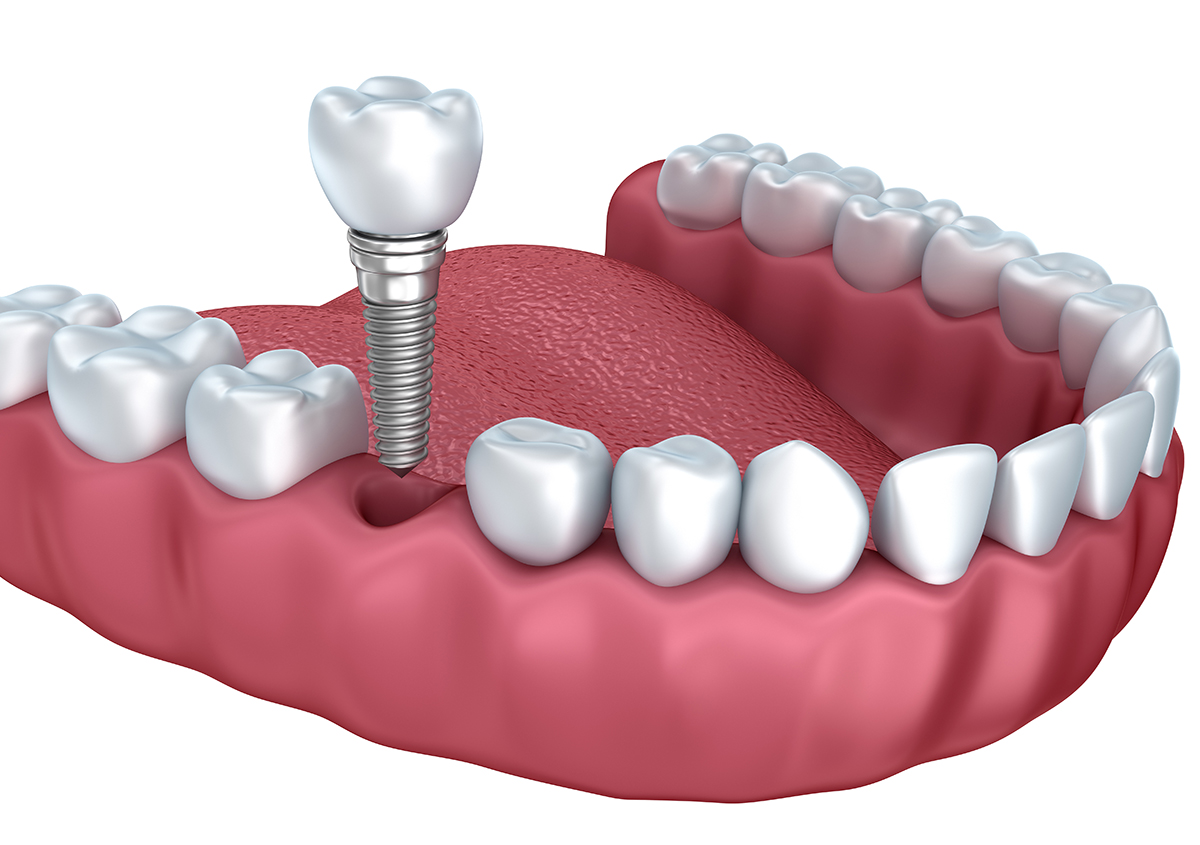 Teeth Implants Dentist in Redlands CA Area